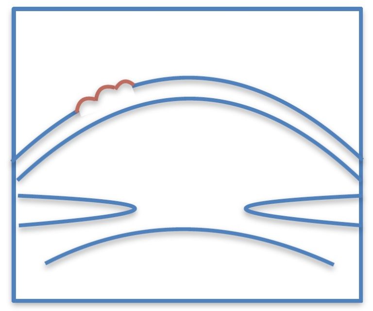 corneal-erosion-syndrome-the-sight-surgery